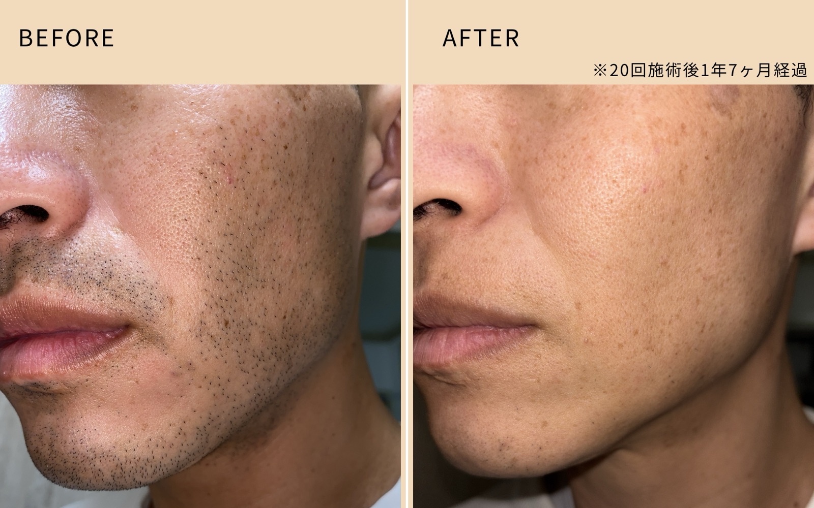 ヒゲ脱毛 Before / After